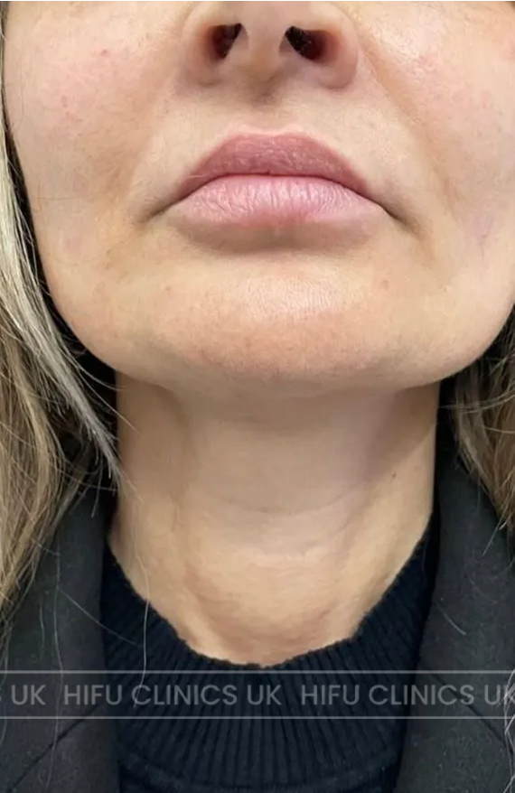 healed results after hifu