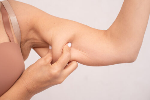 Arm Skin Laxity and the Latest Skin Tightening Solutions